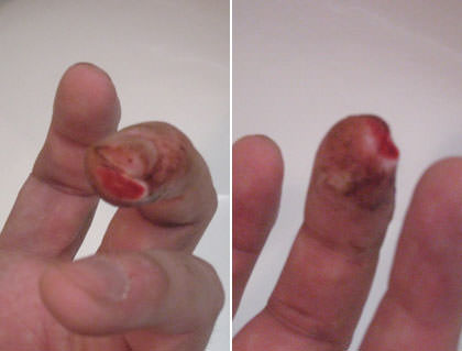 A look at Dave's mutilated finger!