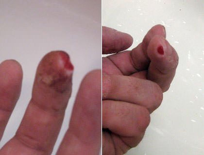 Dave's finger is healing... wound is much smaller now!