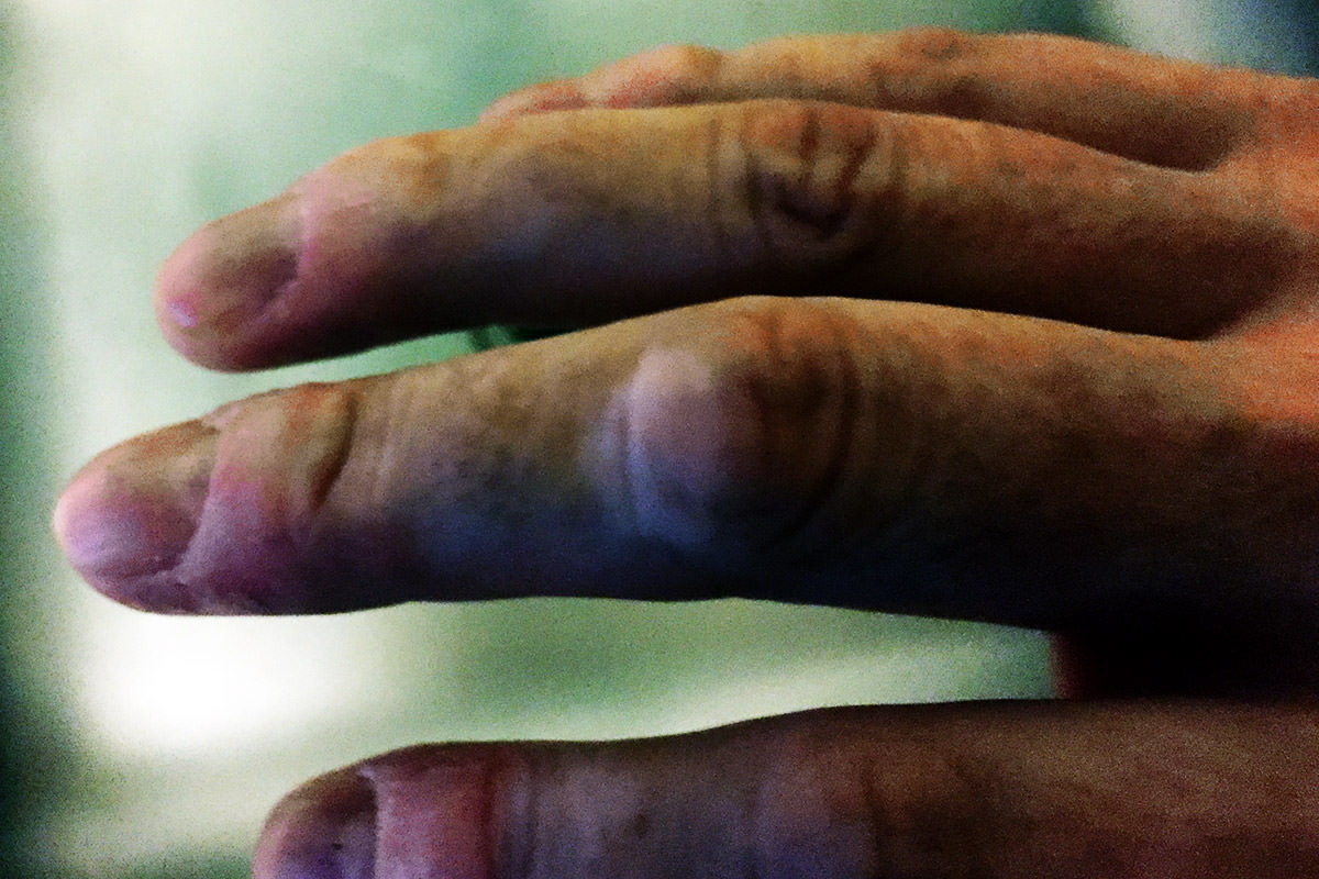 Dave's Vitiligo Hands