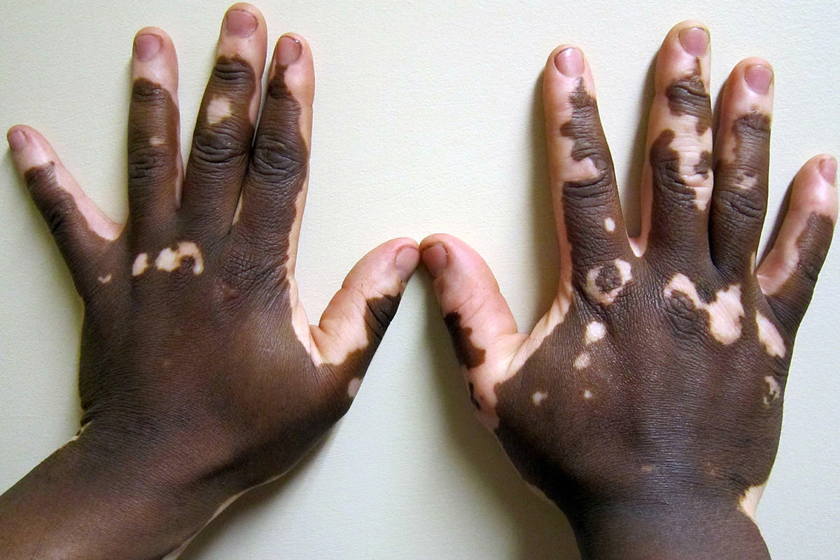 Vitiligo Hands