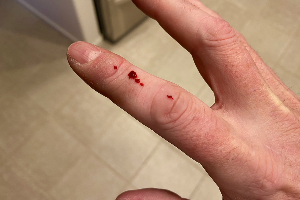 My finger with blood on it from cat claw scratch wounds.