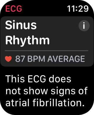 My Apple Watch ECG report.