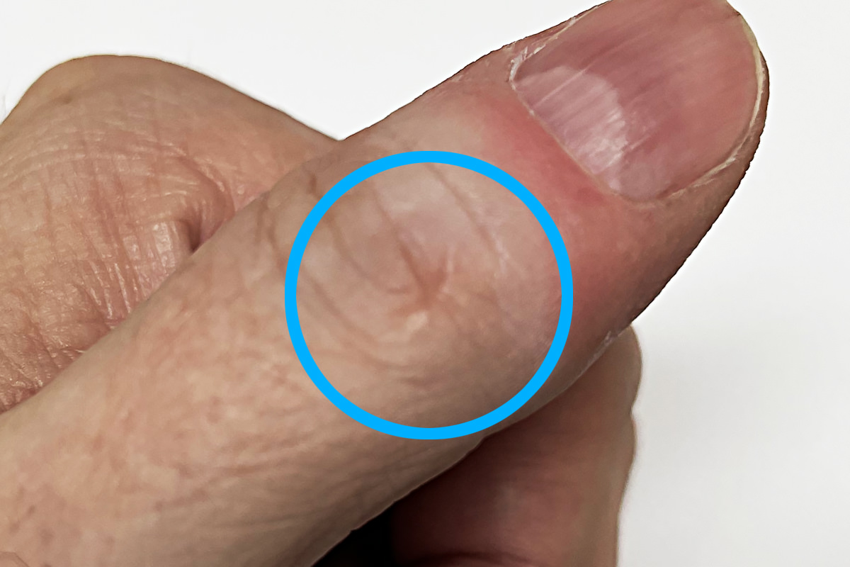 A scar on my thumb knuckle.