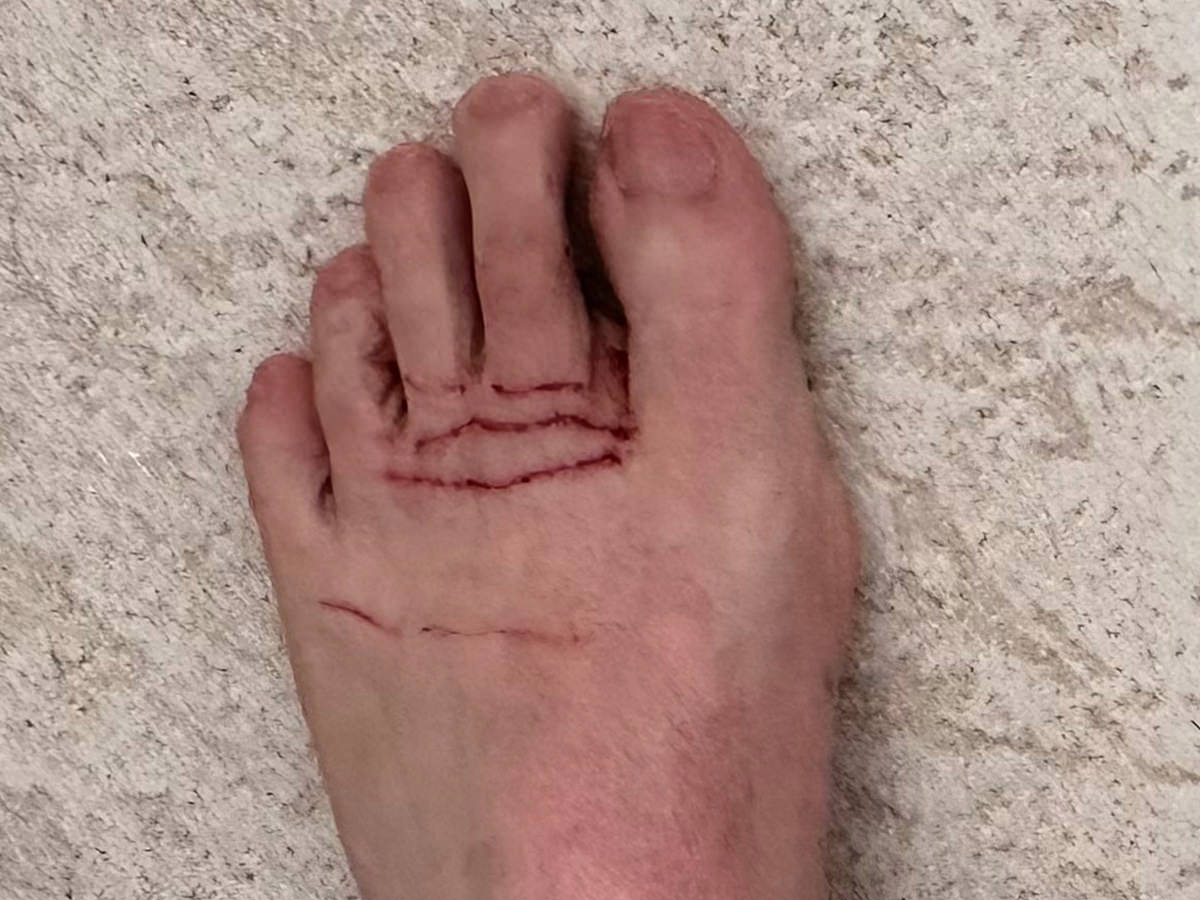 My left foot REALLY cut up.