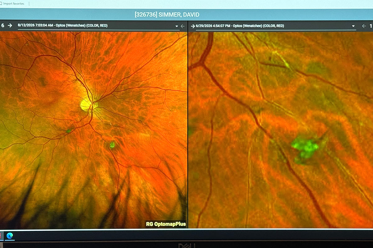 Blood vessels in my eye are not having a good day!