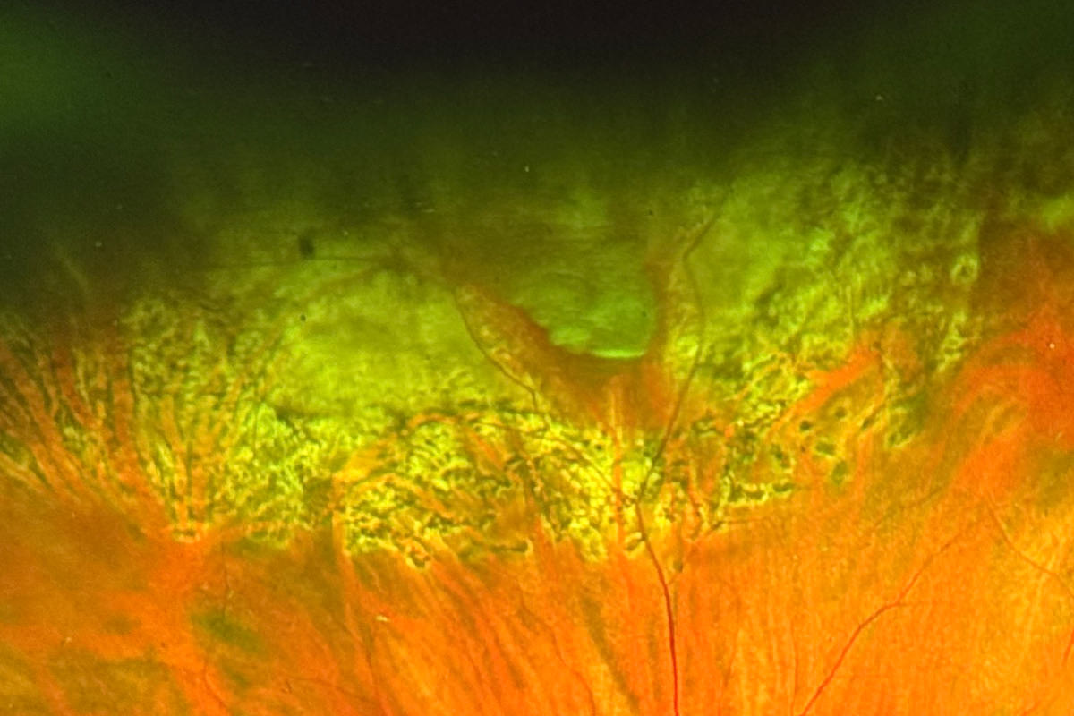 Look at the hundreds of laser holes in my retina!