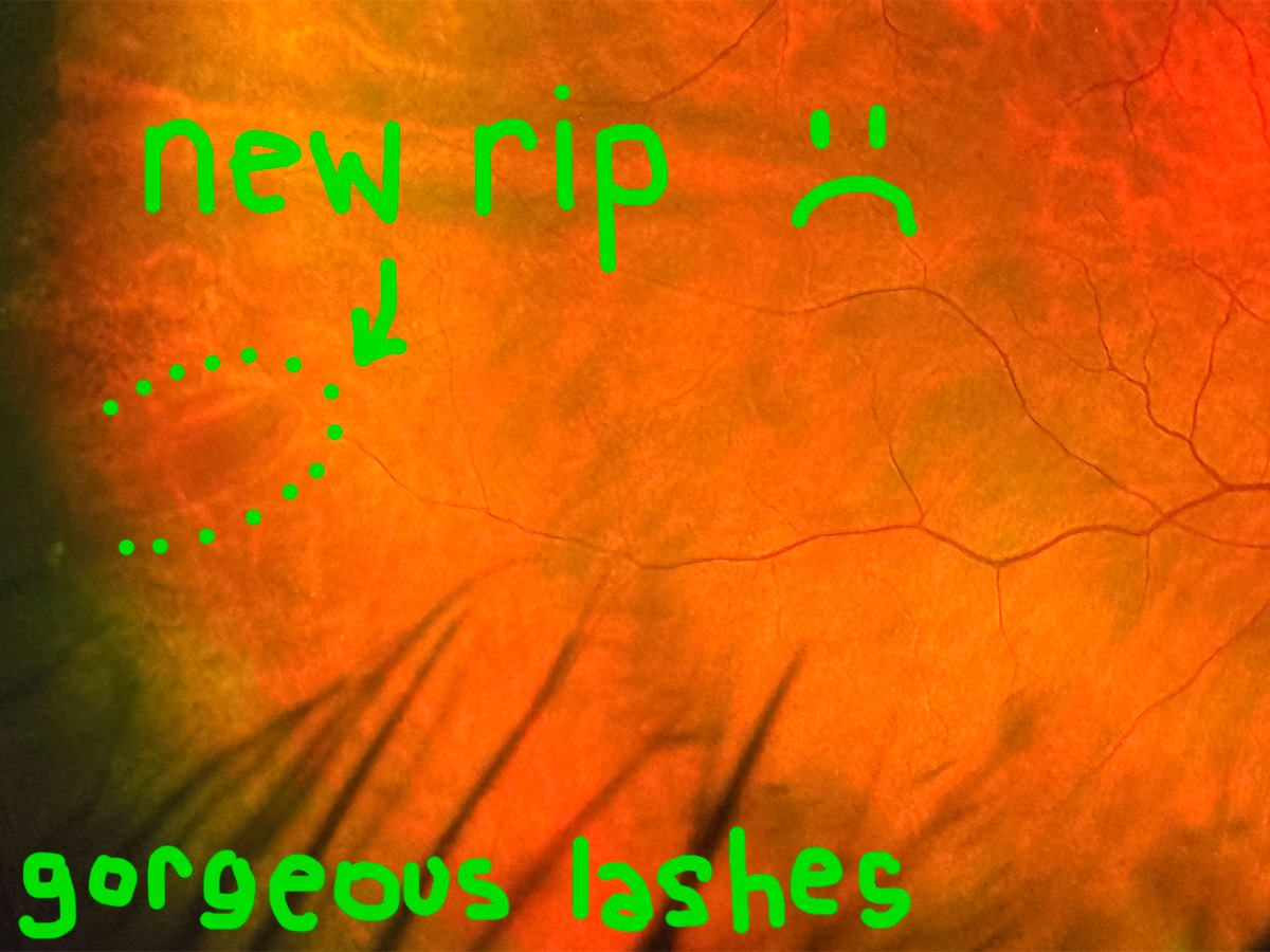 My new rip showing on my eye scan.