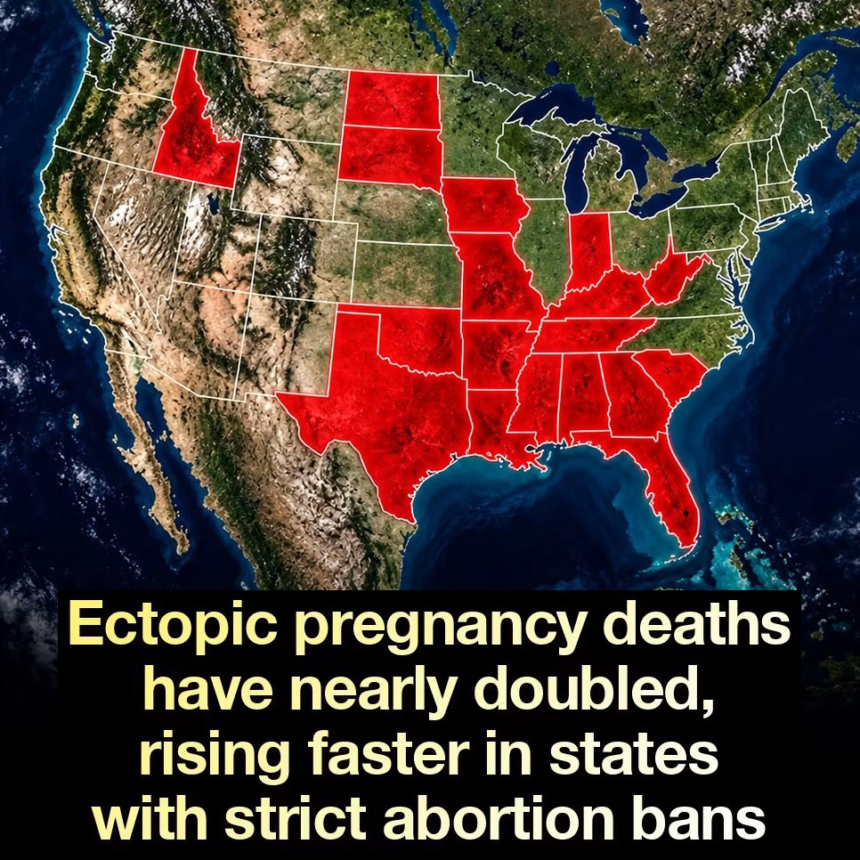 Ectopic pregnancy deaths have nearly doubled, rising faster in states with strict abortion bans.