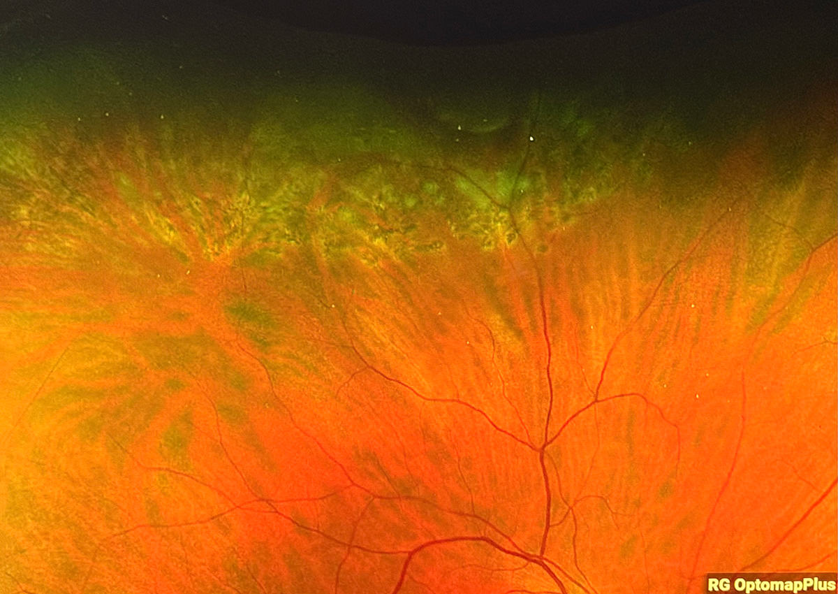Scarred Retinas in my eyeball!