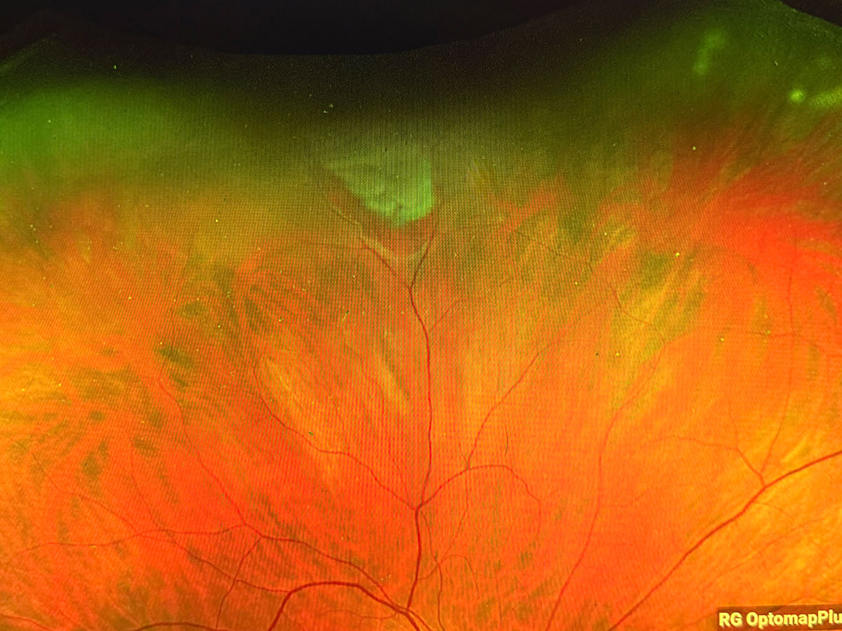 Retinal Tear on My Scan