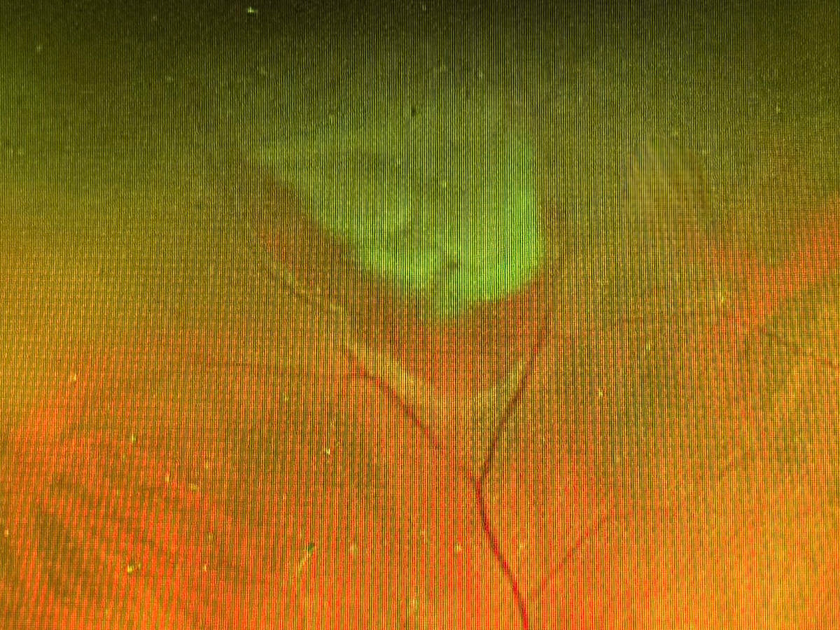 Retinal Tear on My Scan